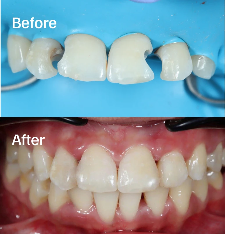 Natural Front Tooth Restoration