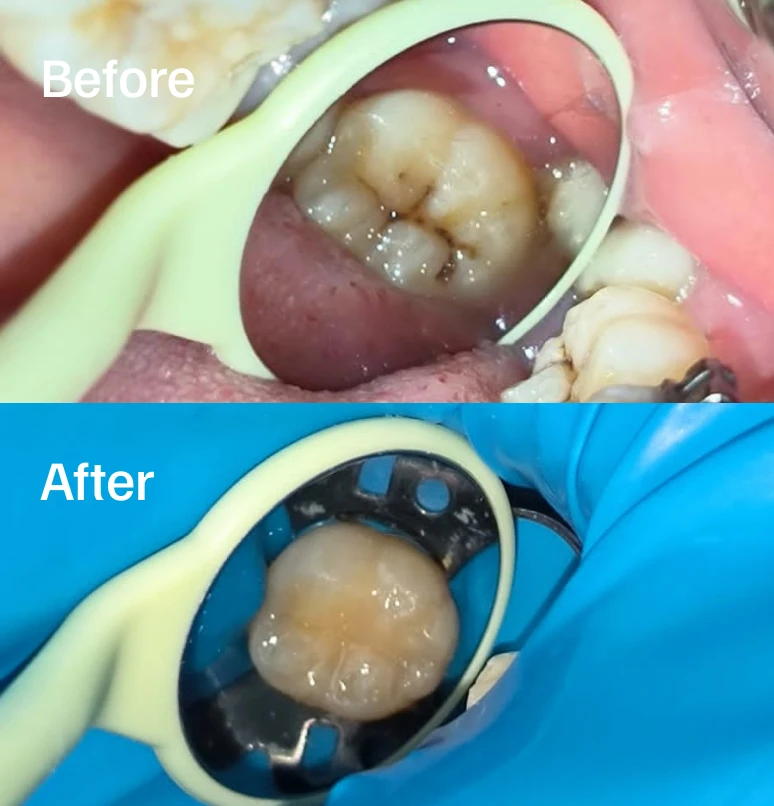 Posterior Aesthetic Restoration