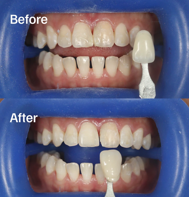 Professional whitening for a radiant smile.