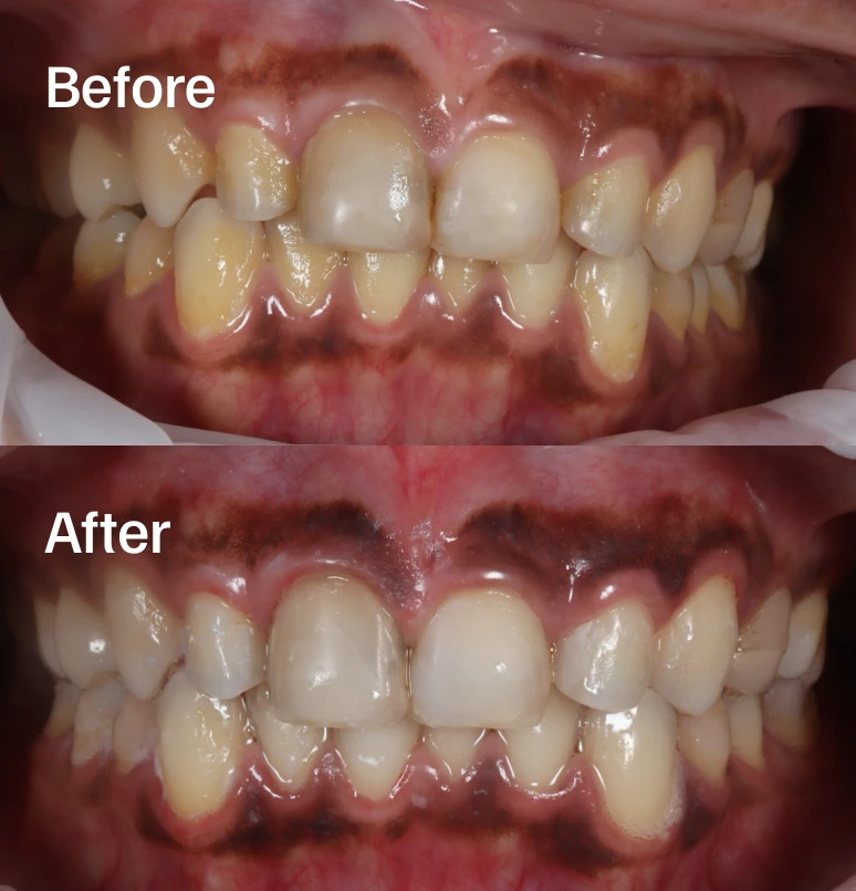 Lift deep stains safely for a naturally brilliant smile.