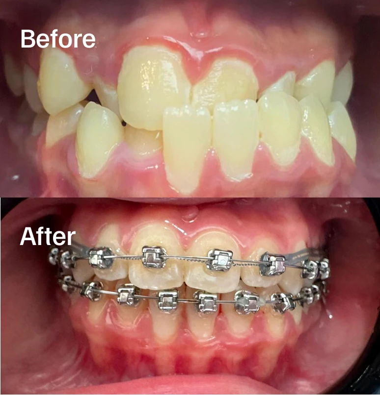 4-month Damon Braces Progress