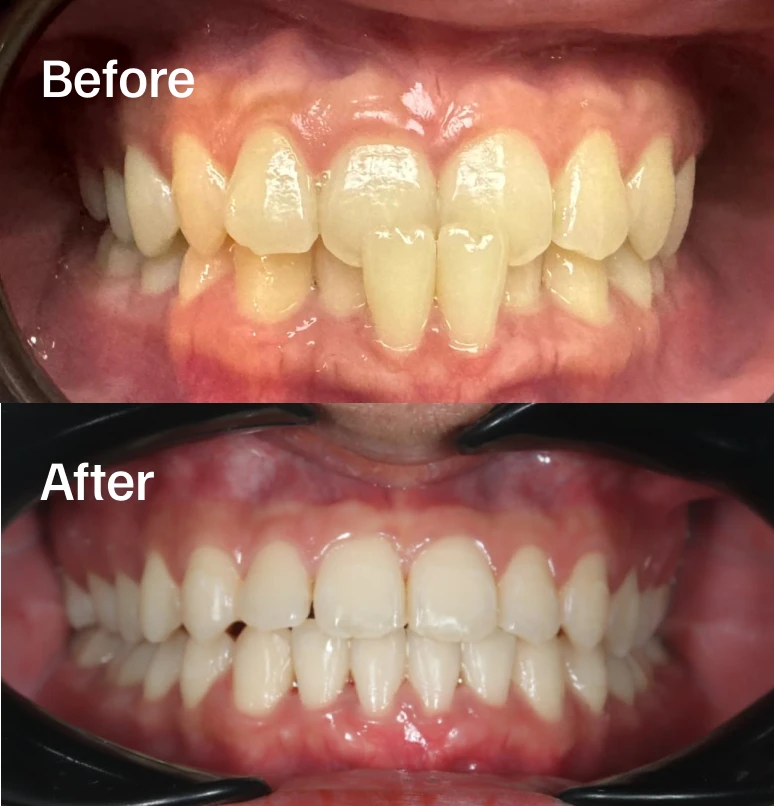 7-month Metal Braces Progress