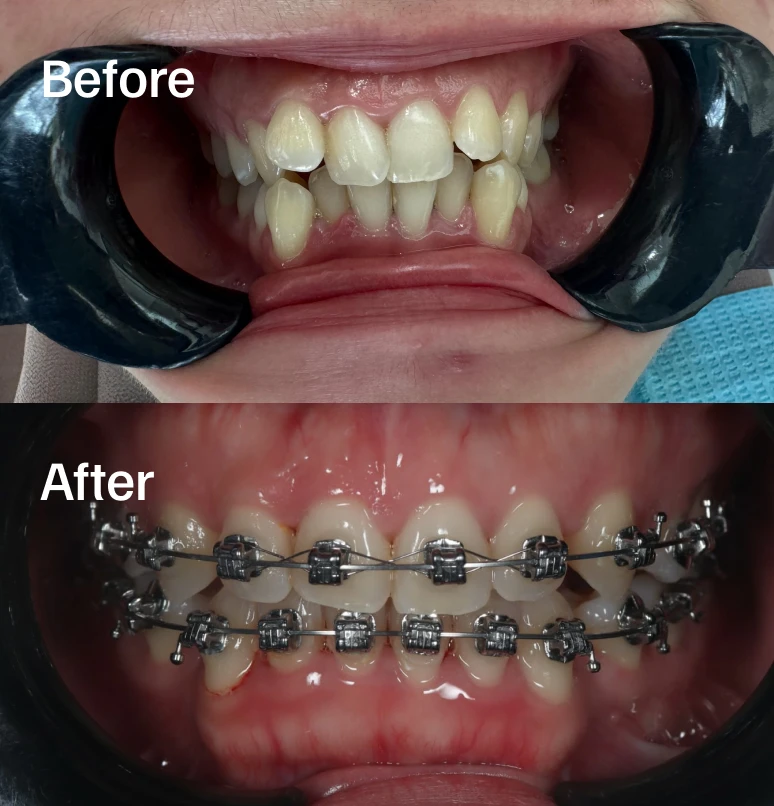 13-month Damon Braces Progress