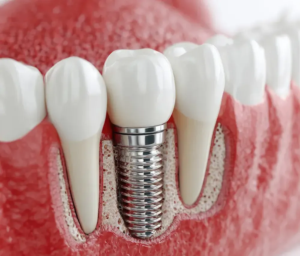 Dental Implant