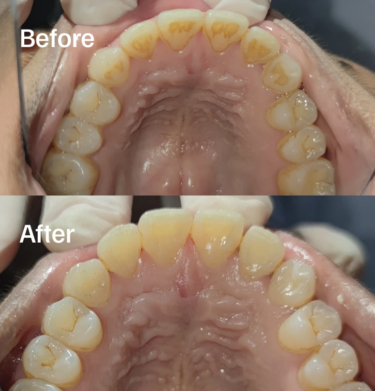 Focused deep cleaning to protect your upper teeth and gums.