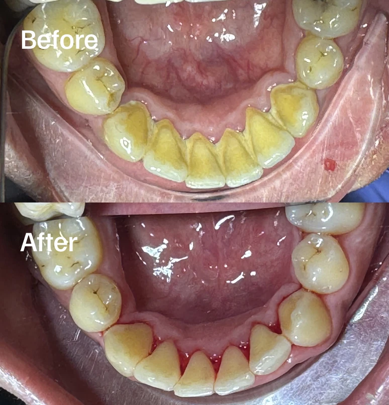 Focused deep cleaning to protect your lower teeth and gums.