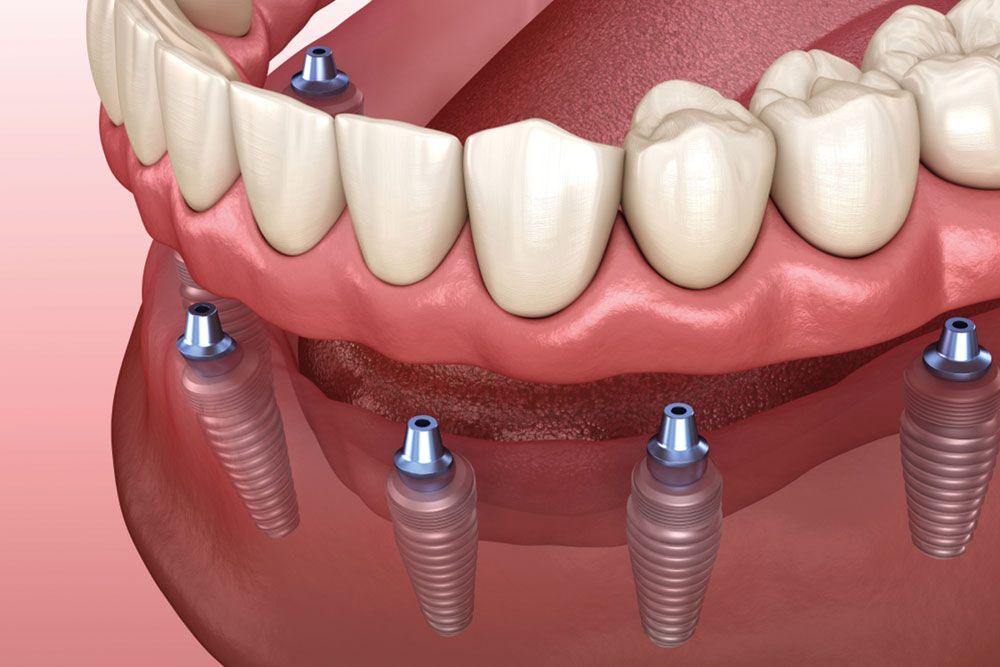 Fixed Denture