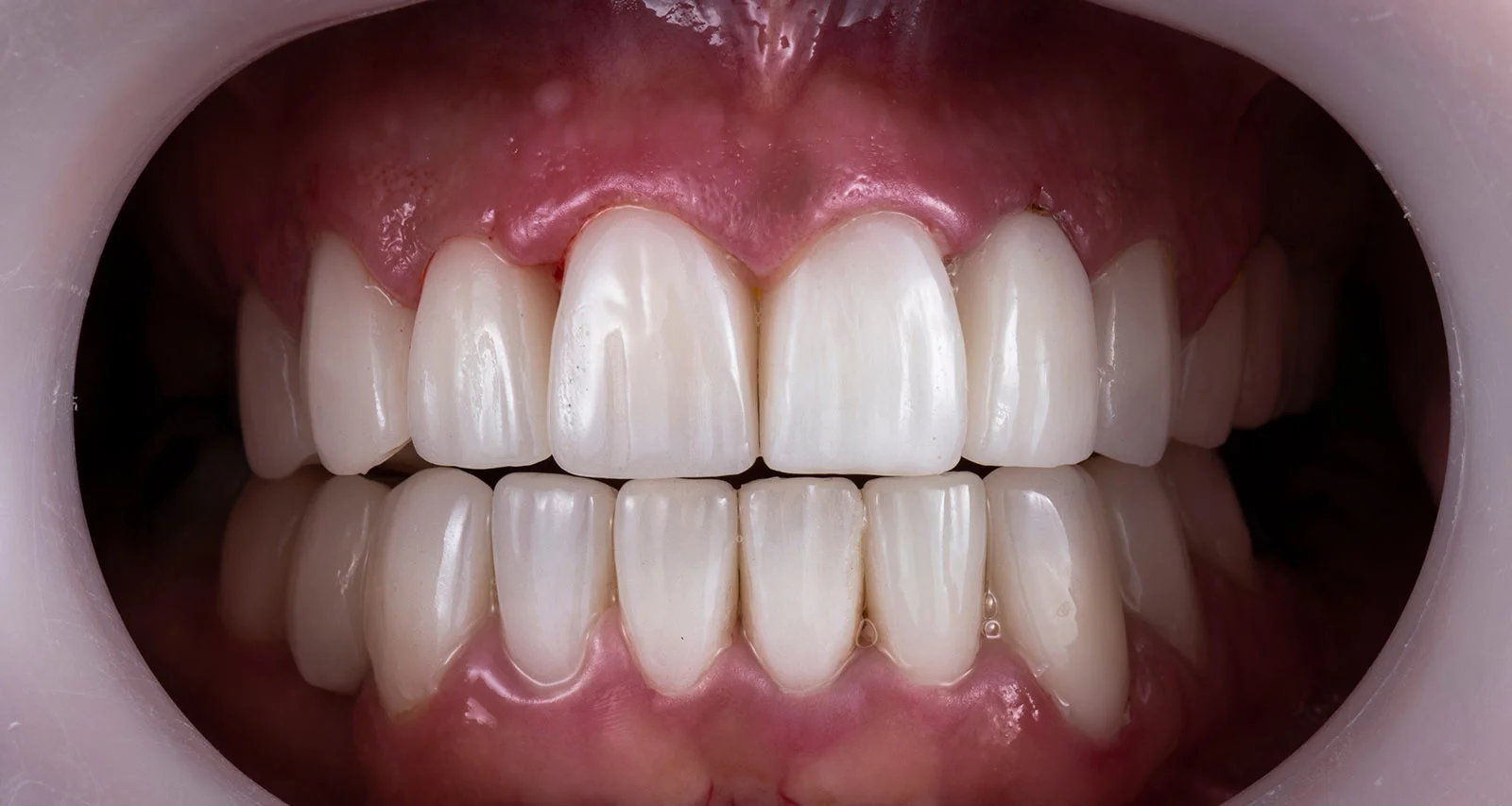 Full Mouth Rehabilitation