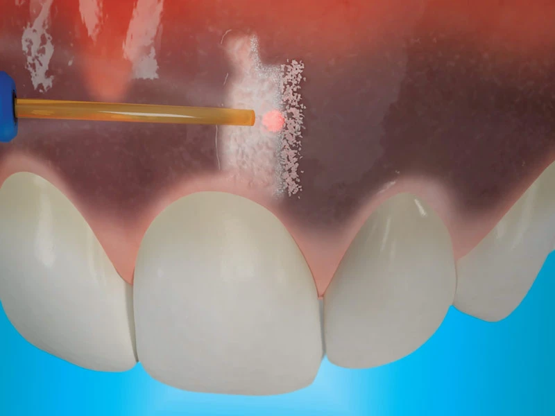 Gum Depigmentation