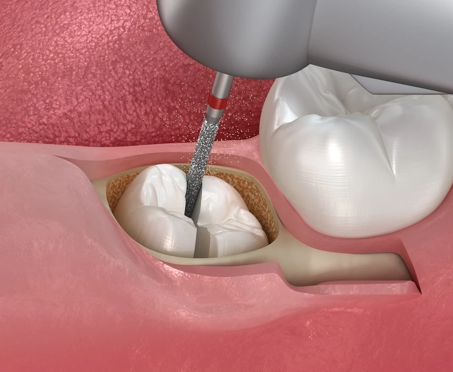 Odontectomy
