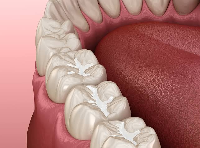 Pit and Fissure Sealant