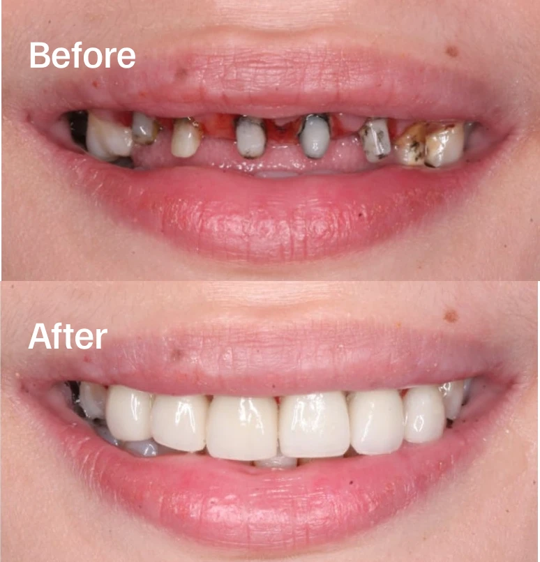 Smile makeover for your personalized smile.
