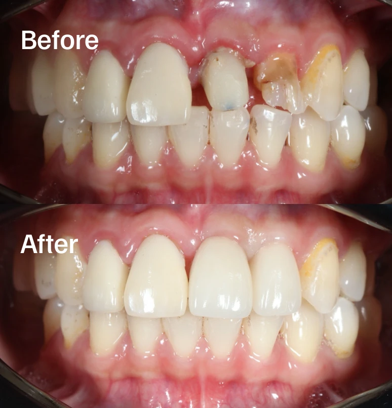 Custom-made crown for a flawless, natural-looking tooth.
